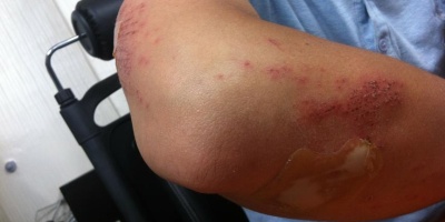 Çabuk İyileştiren Bandaj Geliştirildi