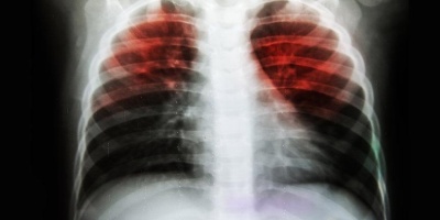 Tüberküloz Hastalığının Belirtileri