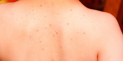 Lekelere Bitkisel Tedavi Yöntemleri