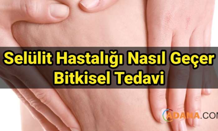 Selülit Hastalığı Nasıl Geçer Bitkisel Tedavi