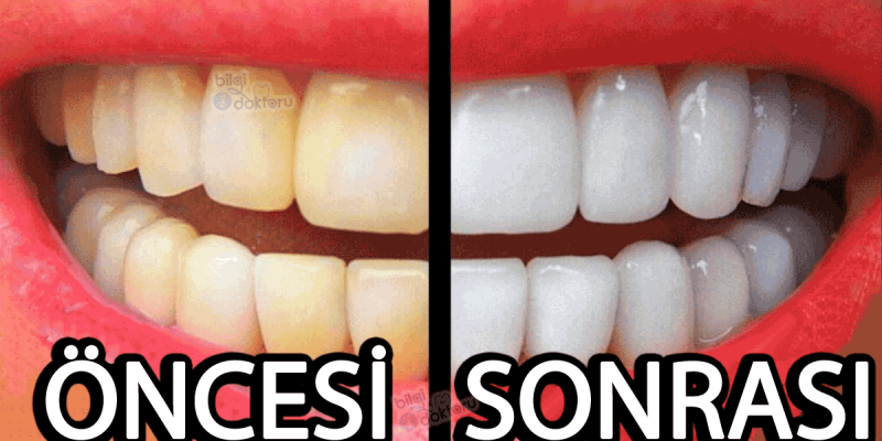 Doktor'a gitmeden bembeyaz Dişler