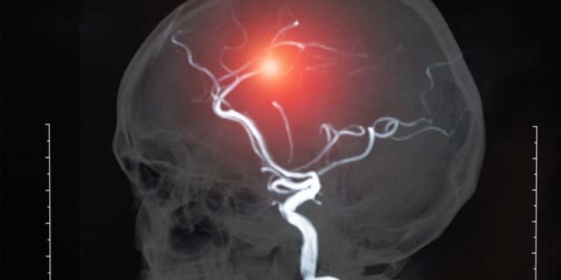 Hiç duymadığınız Karotis darlığı nedir?