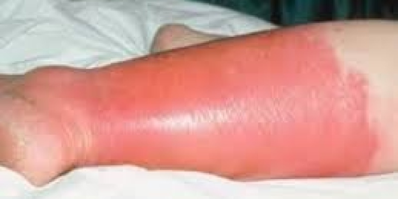 Yılancık Hastalığı...